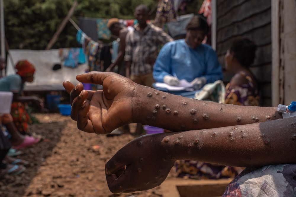 Mpox patient