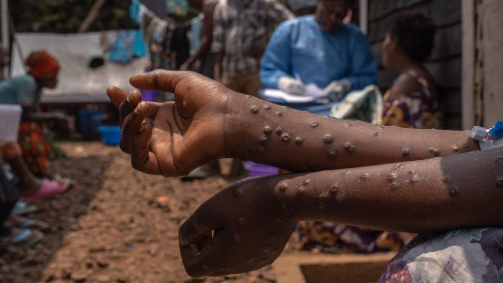 Mpox