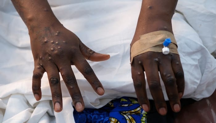 Ghana Reports First Case Of Mpox This Year Strain Yet To Be Identified